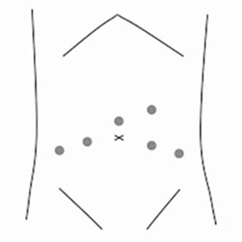 手術の流れ1