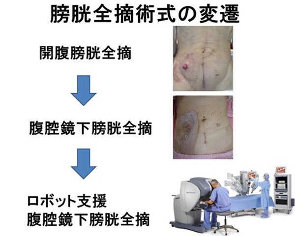 膀胱全摘術式の変遷